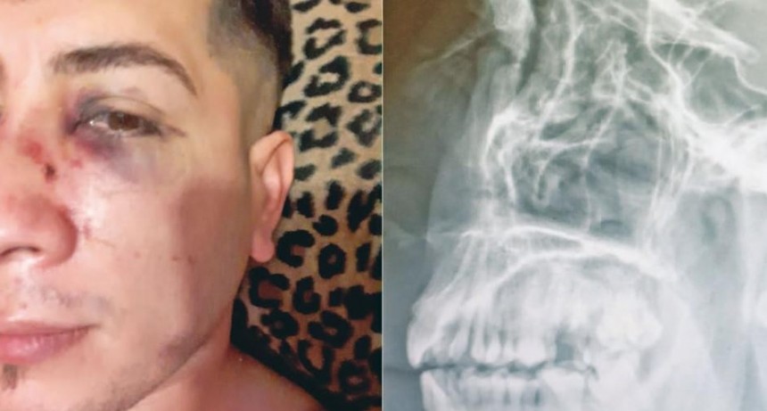 Otra vez los “patovicas” en la mira por una golpiza a un joven al que le fracturaron la nariz